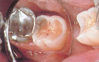 内因性酸蝕症の臼歯部写真