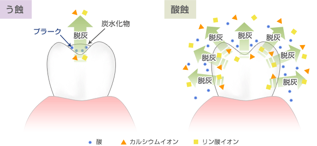 う蝕と酸蝕の図