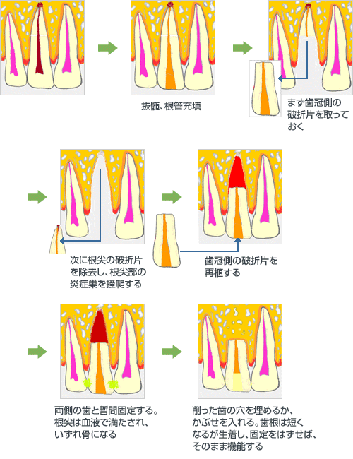 意図的再植術