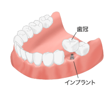 インプラント