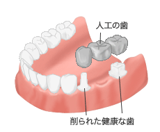 ブリッジ