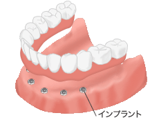 インプラント