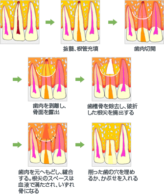 根尖側の歯髄が感染した場合