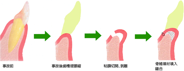 alveolar ridge augmentation の図