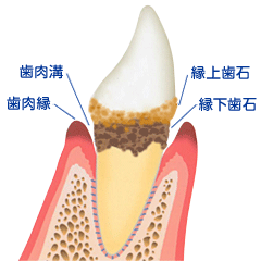 縁下歯石/縁上歯石