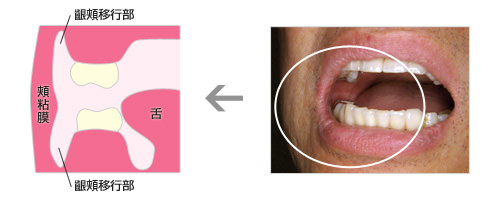 齦頬移行部図