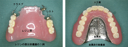 義歯