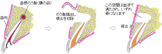 歯根端切除術の図